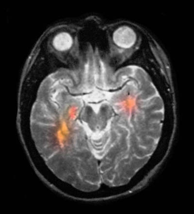 When they escape to the brain, defective immune cells can cause multiple sclerosis